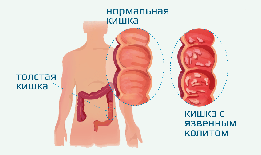 Колит правое