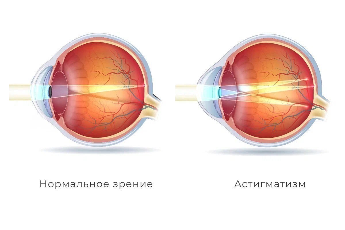 Астигматизм глаз: причины, симптомы, диагностика, лечение и профилактика