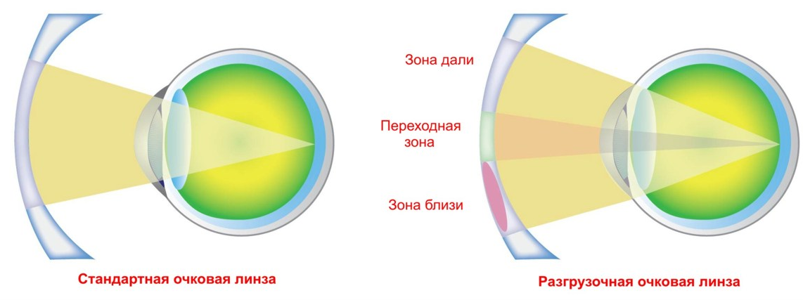 Строение очковой линзы с поддержкой аккомодации 