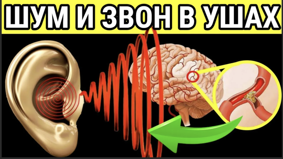 Причины шума в ушах и голове лечение. Шум в ушах звенит. Тиннитус шум в ушах. Шум звон в ушах причины