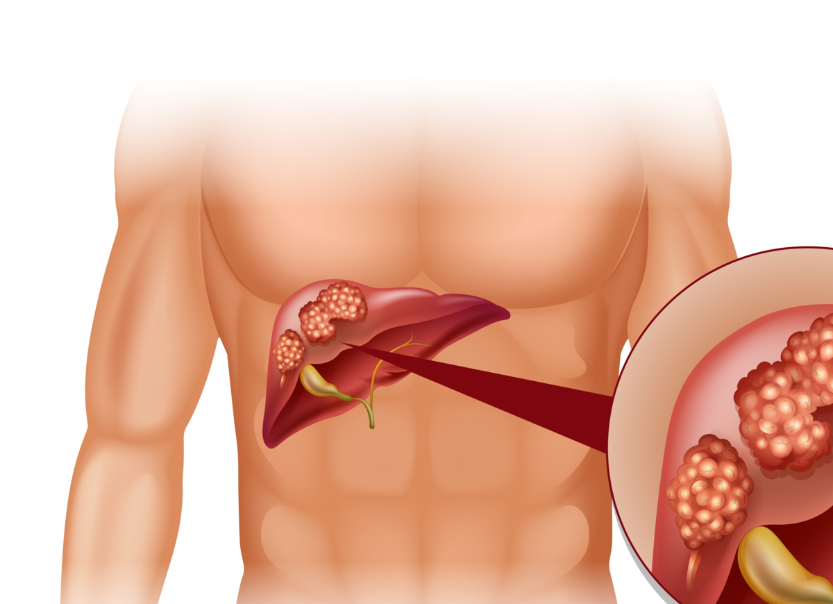 Передается ли рак. Опухоль карцинома печени. Злокачественные поражения печени. Гепатоцеллюлярная карцинома. Фибролипоматоз поджелудочной железы что это такое.