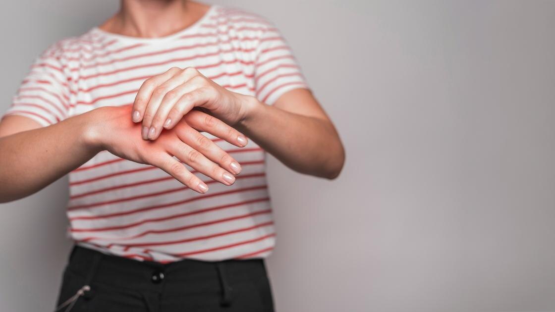    У девушки покраснела рука из-за ожога:Freepik