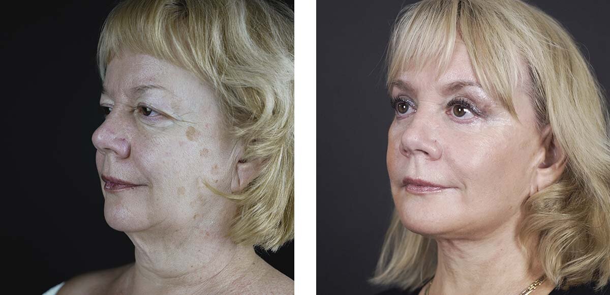 Круговая подтяжка лица и шеи, верхняя и нижняя блефаропластика 