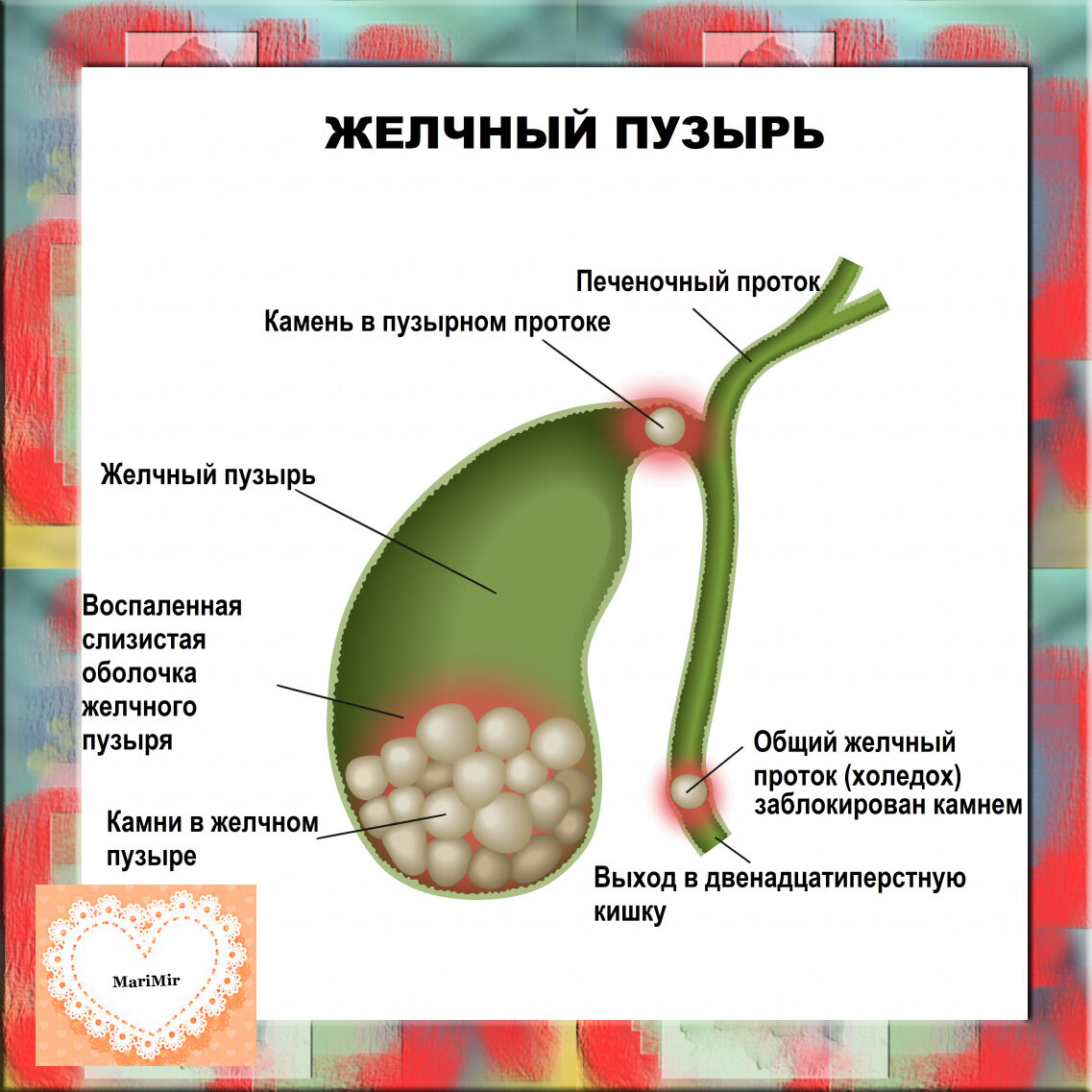 Камень в желчном протоке