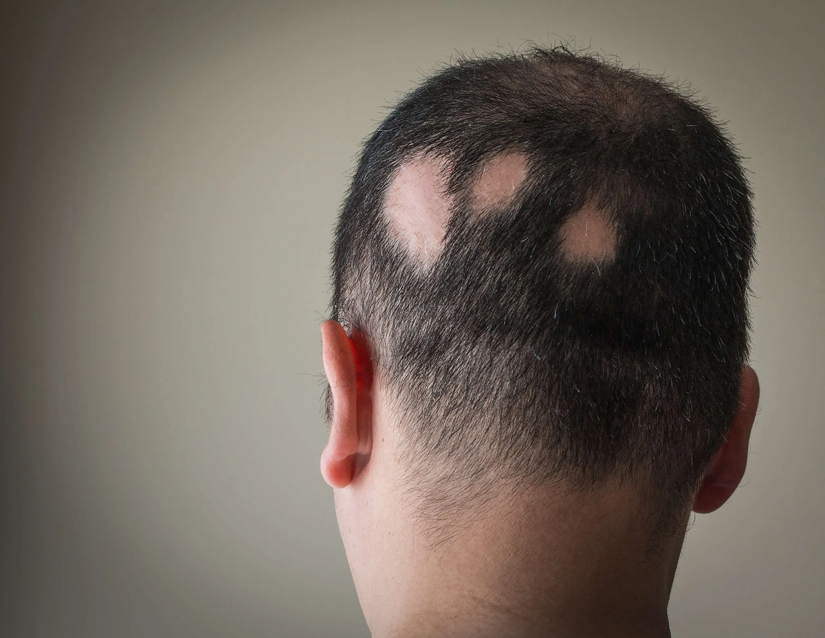 Выпадение волос частями. Очаговая алопеция (alopecia Areata). Очаговая (гнездная) алопеция. Гнездная алопеция офиазис. Гнездная алопеция у мужчин.