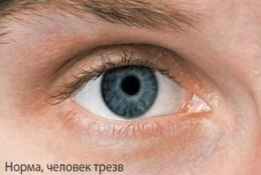 Нормальный зрачок человека