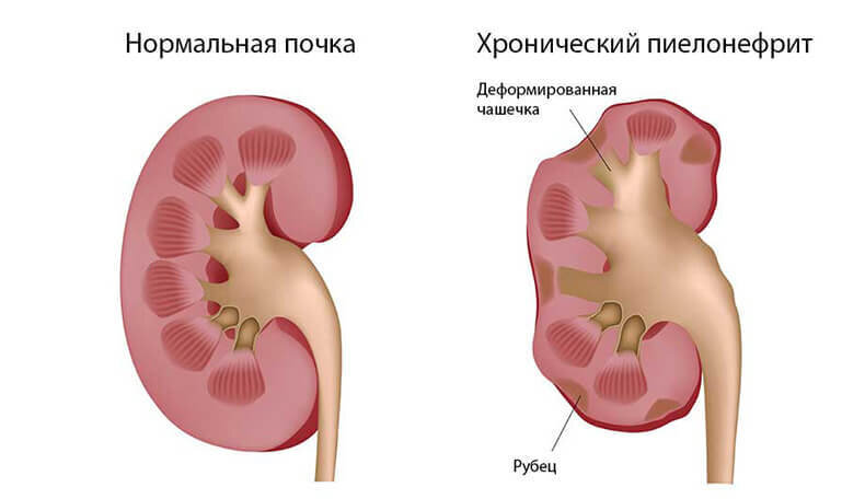 Стол 7 при пиелонефрите