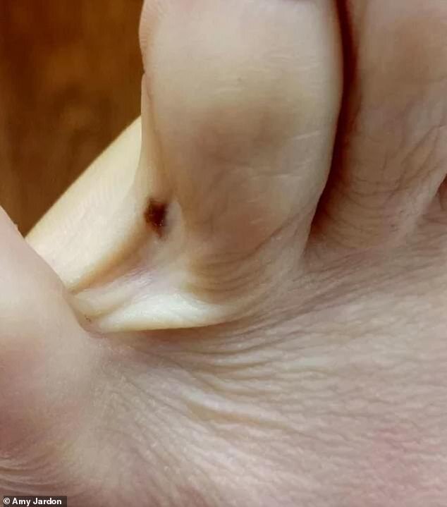 Грибок на ногах - профилактика и эффективное лечение | Статьи медицинского центра «СМ-Клиника»