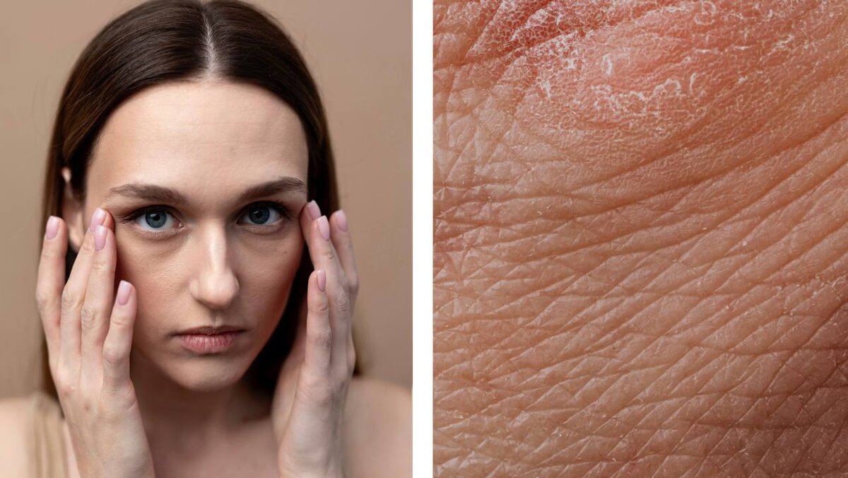 чувствительная кожа. сухая кожа тела причины и что делать. чувствительная кожа лица. сухая кожа тела причины и что делать. обезвоживание кожи.