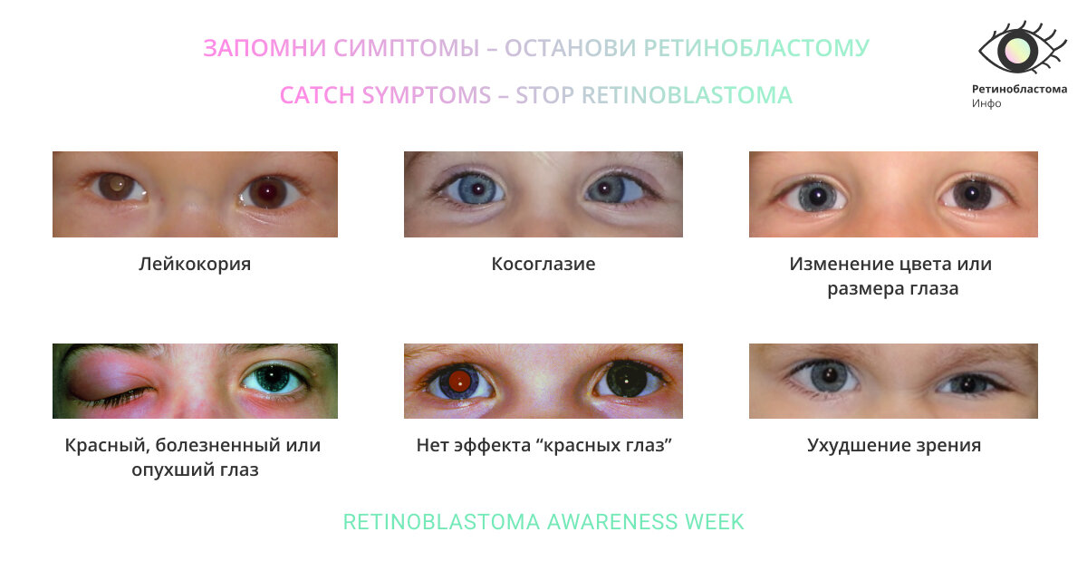 Если глазик светится: офтальмолог Татьяна Ушакова рассказала о признаках  детского рака сетчатки | Помощь редким | Дзен