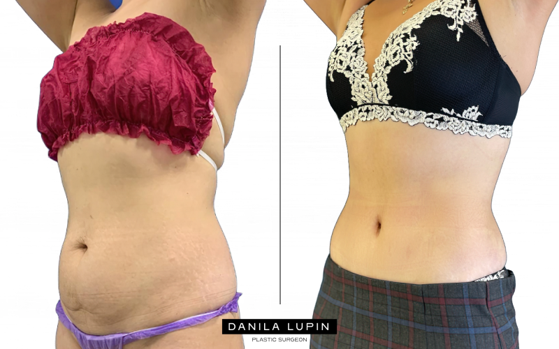 Абдоминопластика до и после. На фото пациентка Данилы Лупина. Имеются противопоказания, необходима консультация специалиста