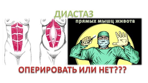 Диастаз прямых мышц живота нужно ли оперировать Виды операций.