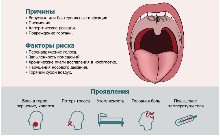 Научная статья Зубаревой Александры Игоревны по теме: Ларингит