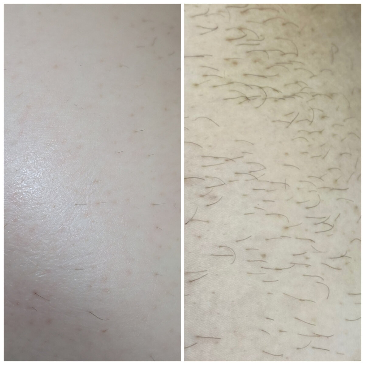 Бедро, в процессе курса и ДО