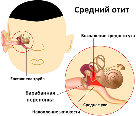 Что такое наружный отит и как он лечится?