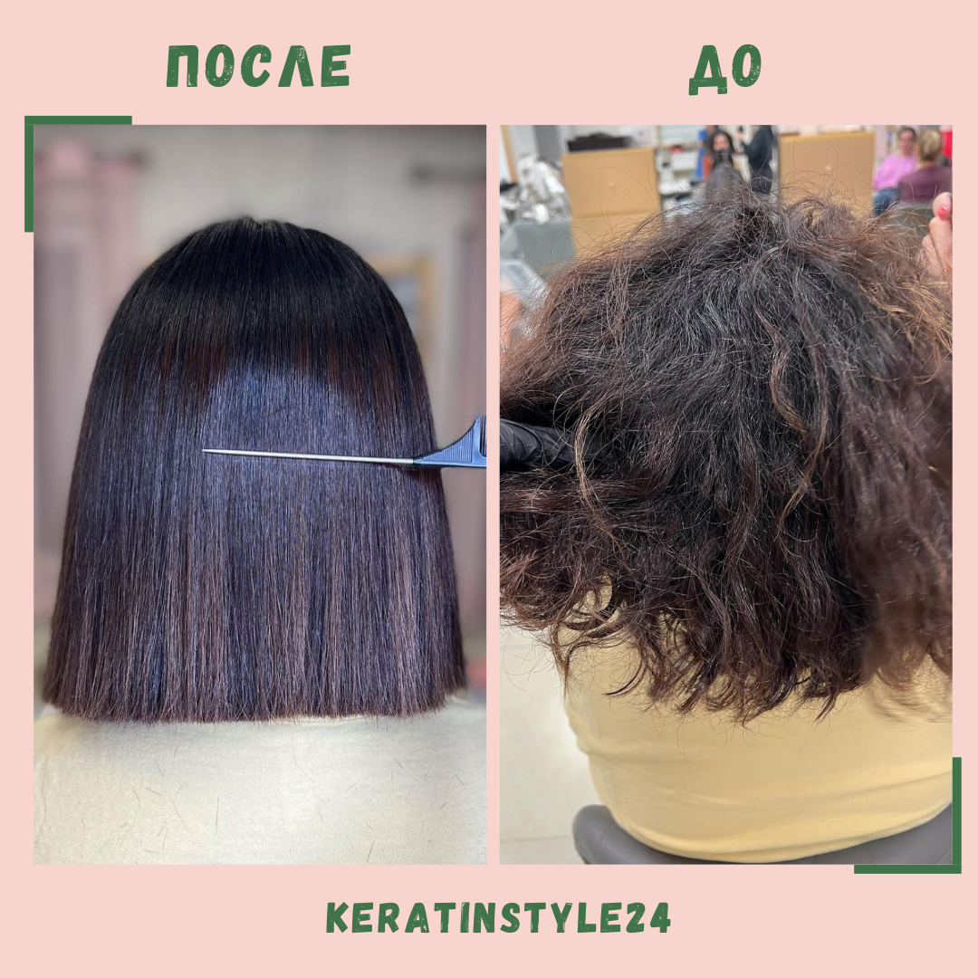 Нанопластика - до /после процедуры