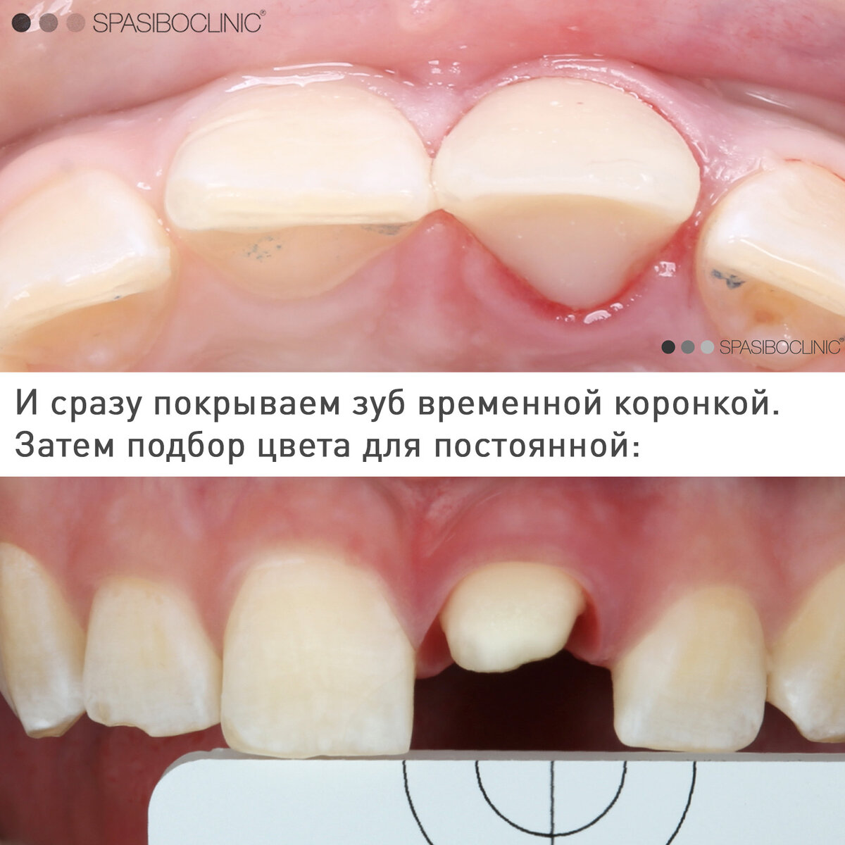 ПЕРЕЛОМ КОРНЯ | Спасибо.Клиник | Дзен