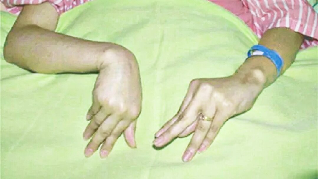 Тетания мышц 