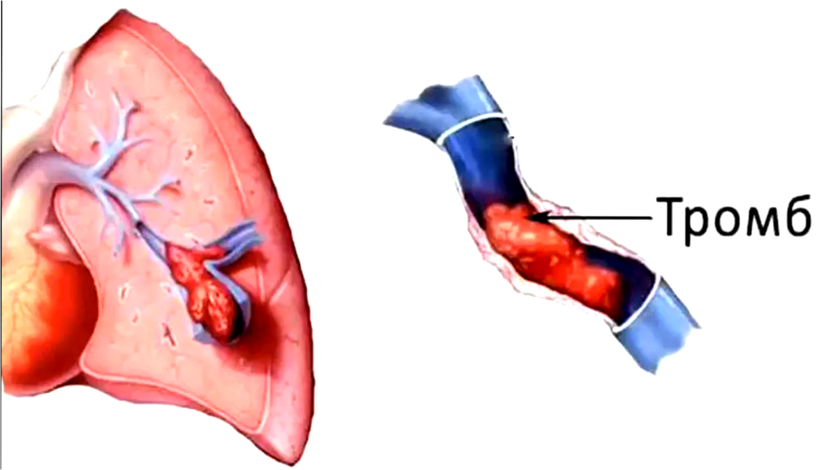 Тромба сердце причины. Тромб в легочной артерии. Тромбэктомия легочной артерии. Тромбо легочная эмболия.