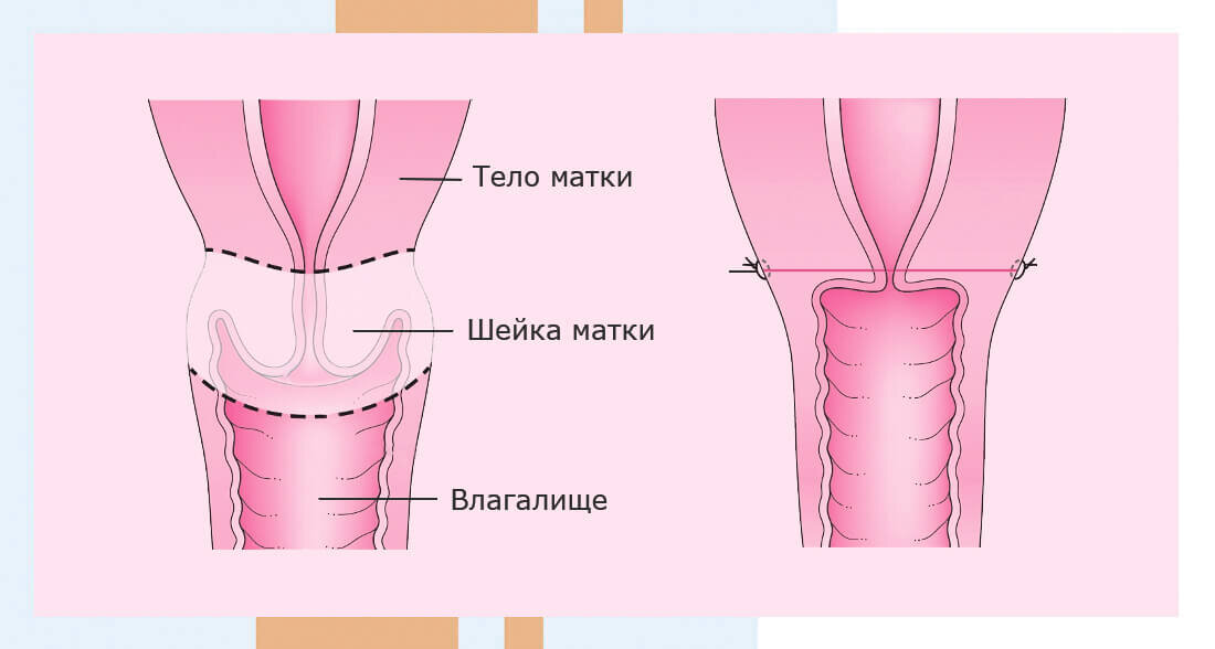 Пластика влагалища