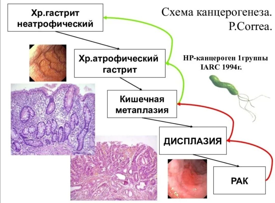 Схема этапов развития рака желудка. Обратите внимание на бактерию Helicobacter pylori, являющуюся одной из основных причин развития гастрита в целом и аденокарциномы в частности.