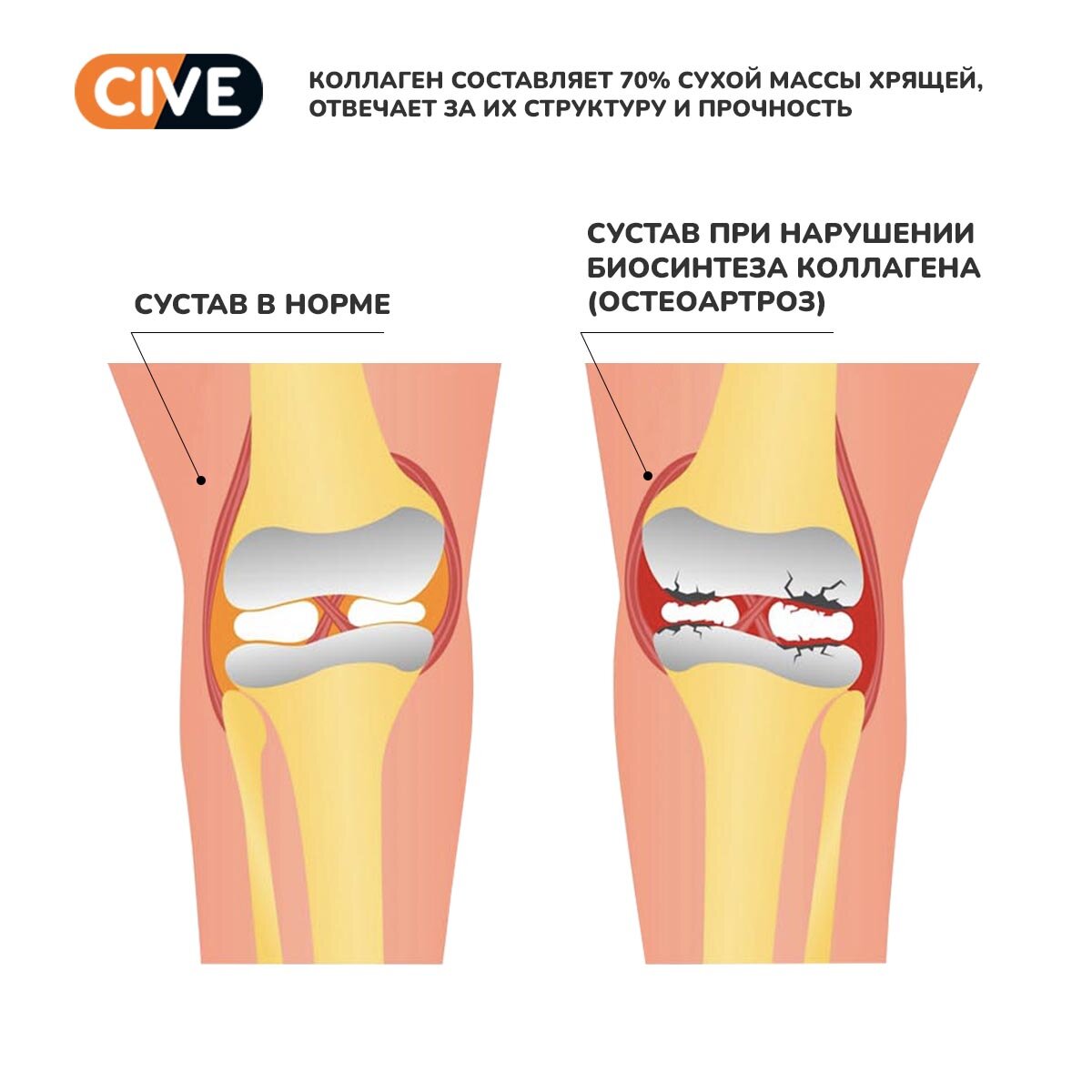 Коллаген помогает при лечении болезни суставов