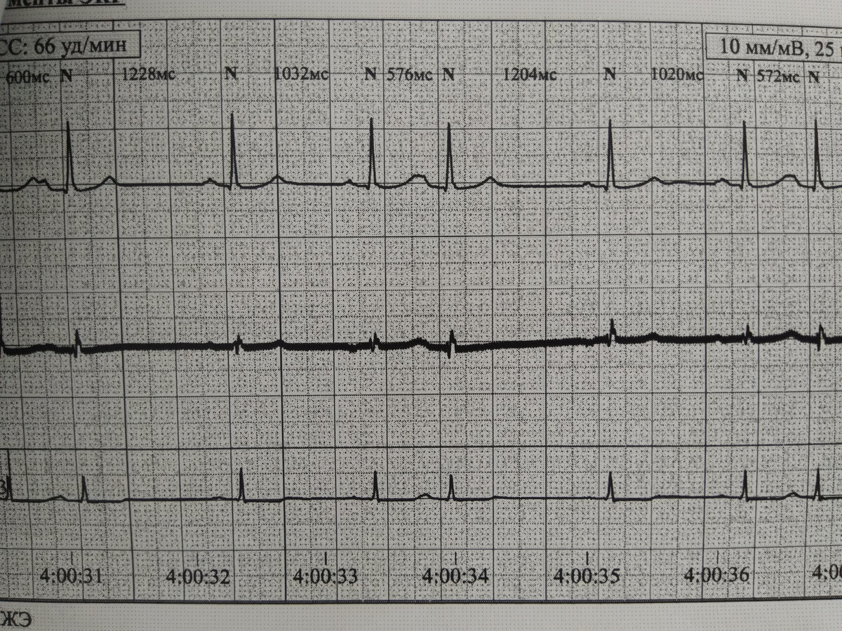 Фото автора. Экстрасистолы... Тяжело с ними...
