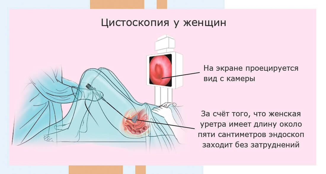 Цистит и секс - ответов на форуме chelmass.ru ()