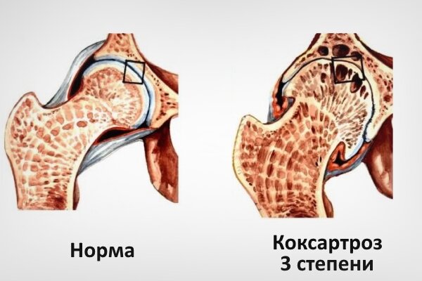 Что такое артроз и можно ли его вылечить