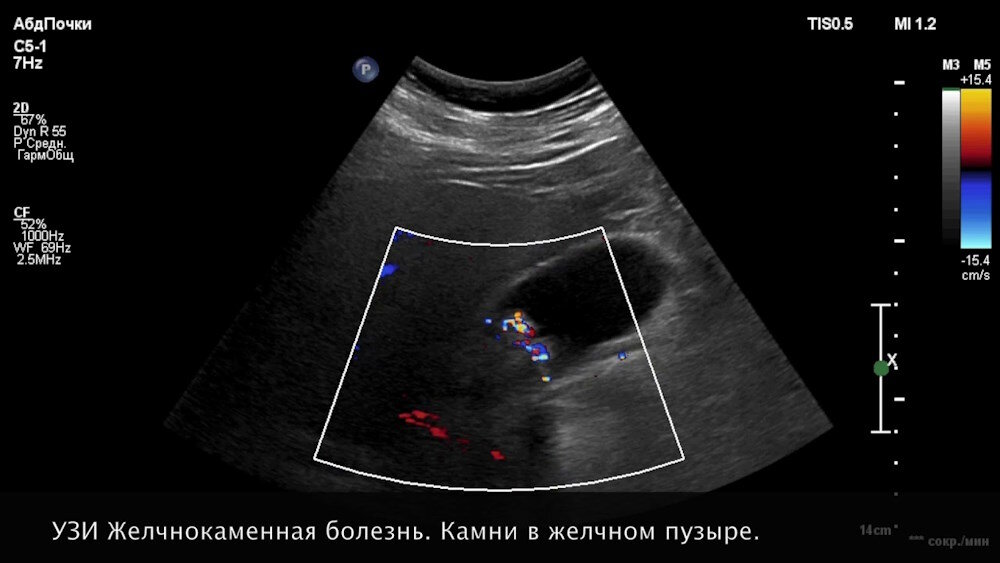 Показания и противопоказания к лапароскопической холецистэктомии