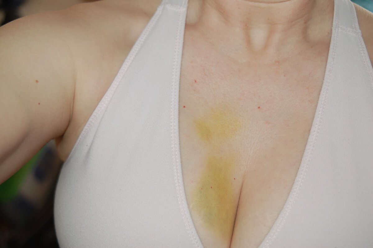 гематома в груди у женщин фото 5