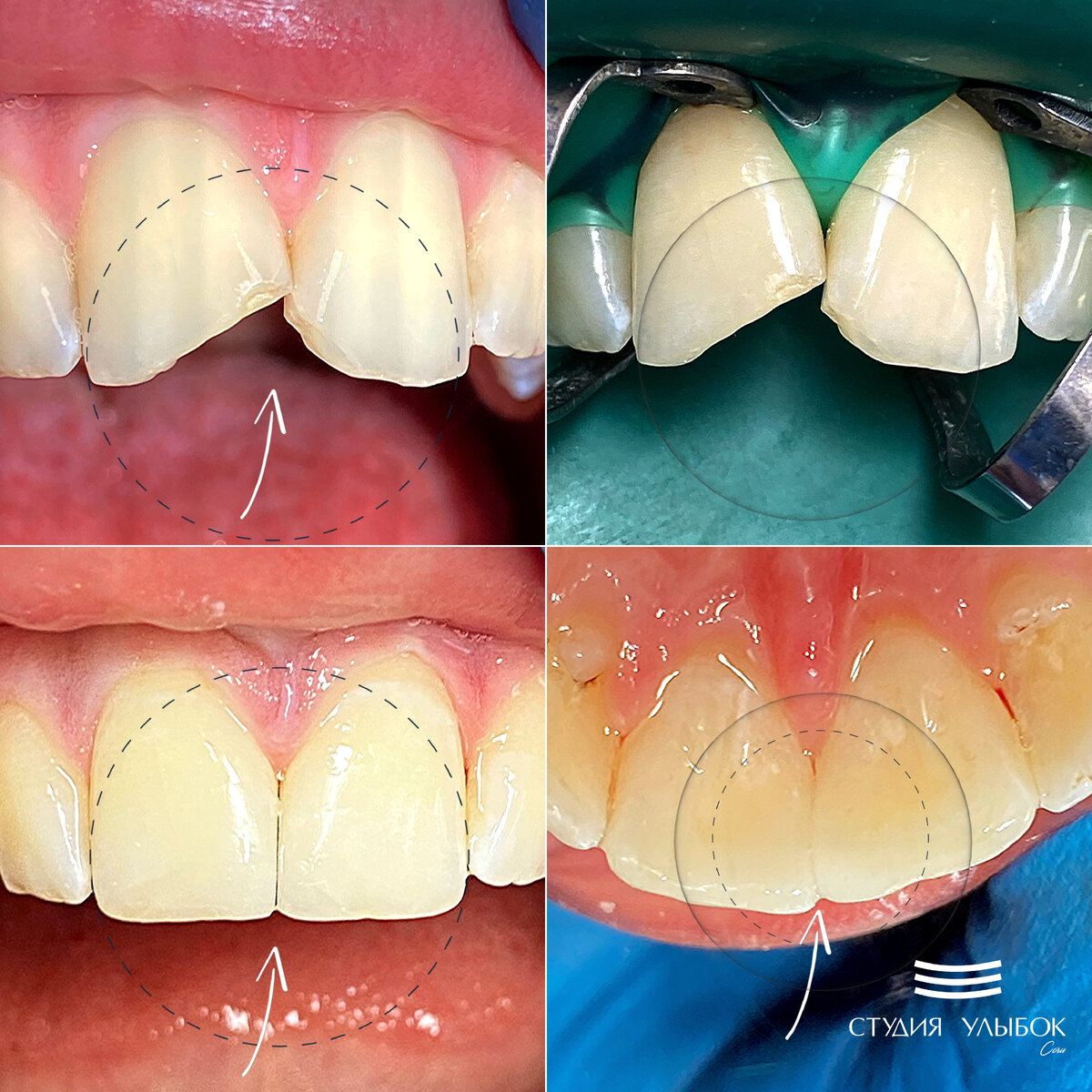 Результат реставрации. Реставрация фронтальных зубов. Реставрация передних зубов. Восстановление передних резцов. Реставрация переднего зуба до и после.
