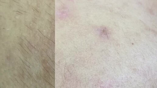 ЭЛЕКТРОЭПИЛЯЦИЯ МОСКВА | На видео Вы можете увидеть реакцию кожи сразу ...