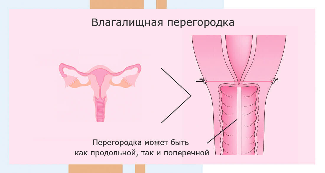 Климакс. Опущение матки и другие изменения в интимной сфере у женщин 40+