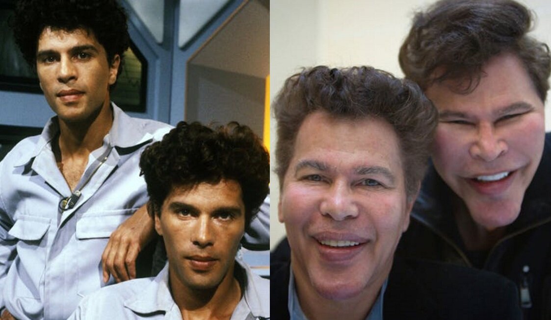 Братья Богдановы до и после пластики. Фото из открытого источника