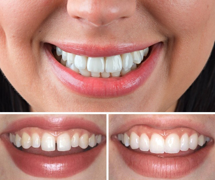 Реставрация зубов — плюсы и минусы | Цифровая стоматология Денталь в ...