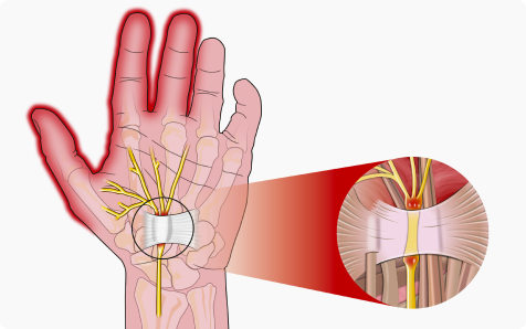 Срединный нерв, кровеносные сосуды и сухожилия проходят в запястье через запястный канал или туннель. При возникновении отека запястья канал сдавливается и защемляет срединный нерв, что и вызывает дискомфортные ощущения.