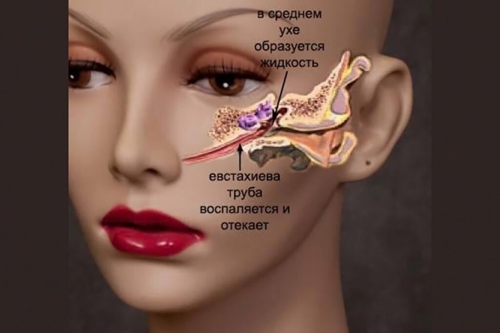 Экссудативный средний отит у детей | Информация о слухе от центра Слуховые системы