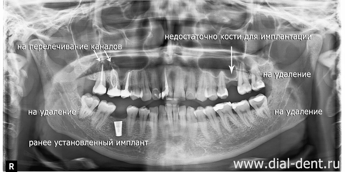 фрагмент компьютерной томограммы зубов до лечения