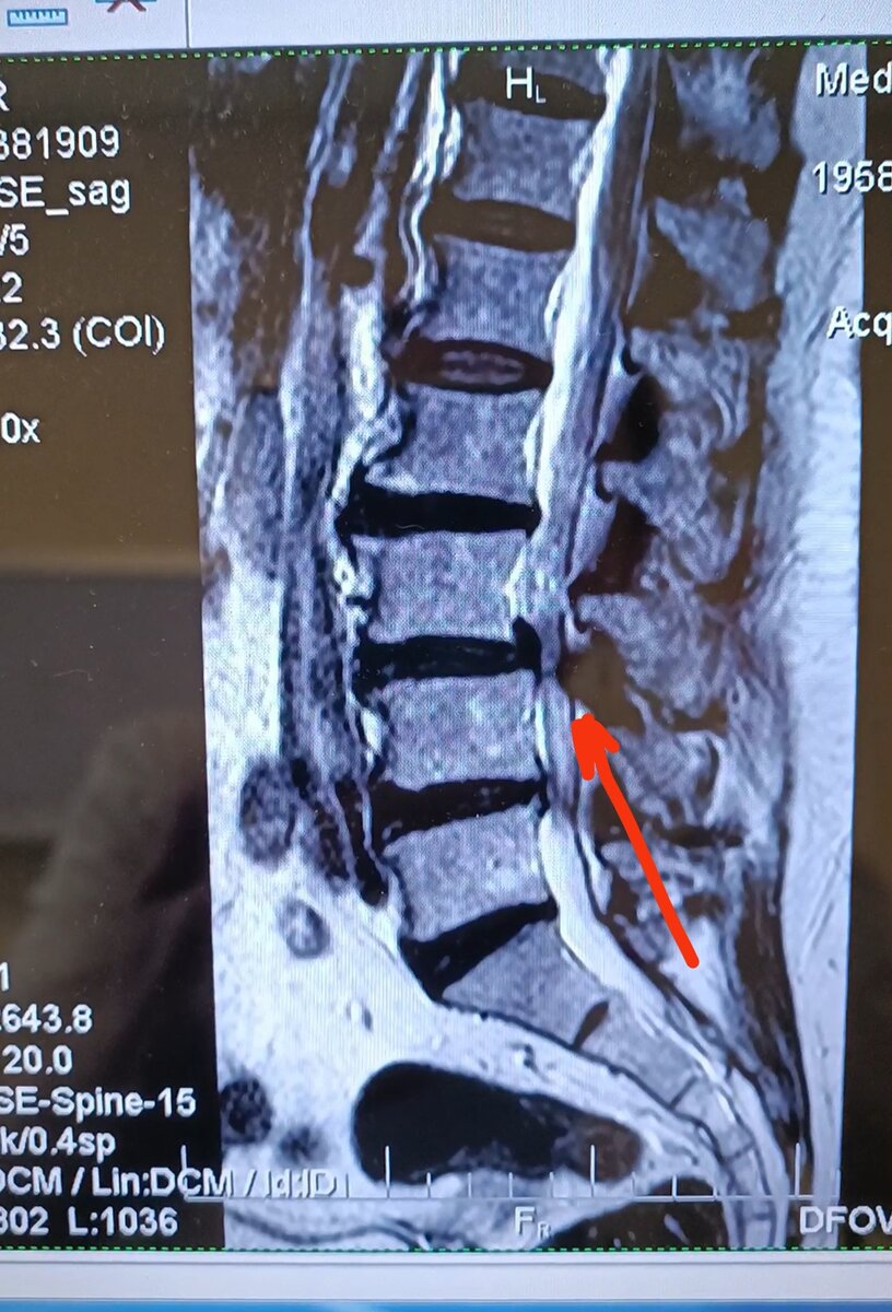 спинальный стеноз с6-с7. перелом отростков позвоночника l2-3. симптомы поражения спинного мозга. стеноз корешковых каналов поясничного отдела. врожденный стеноз позвоночного канала.