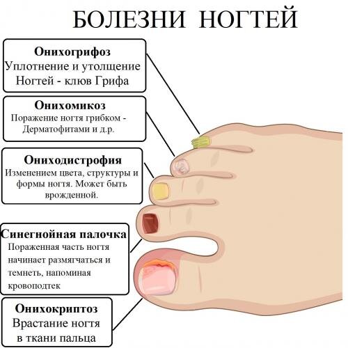 Помимо грибка ногтей, есть и другие болезни, поражающие ногтевые пластины. Вопросами болезней и врастаний ногтей, а таже стоп занимается специалист-подолог.