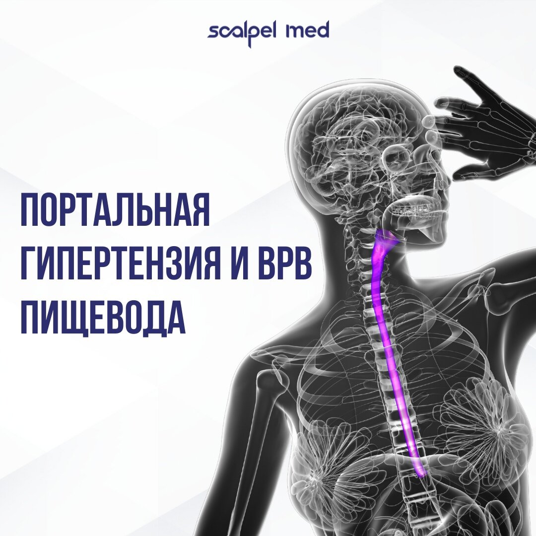 Портальная гипертензия и врв пишевода