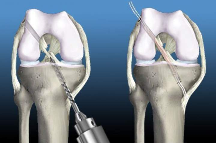 Лечение разрыва связок коленного сустава