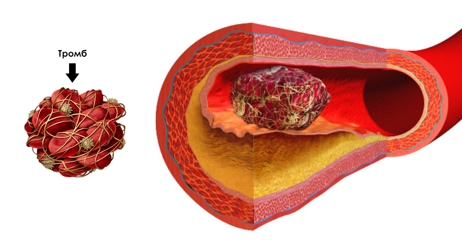 Тромбоз кровеносных сосудов. Тромбоэмболия кровеносного сосуда. Тромбоз пузырной артерии. Тромб в кровеносном сосуде.