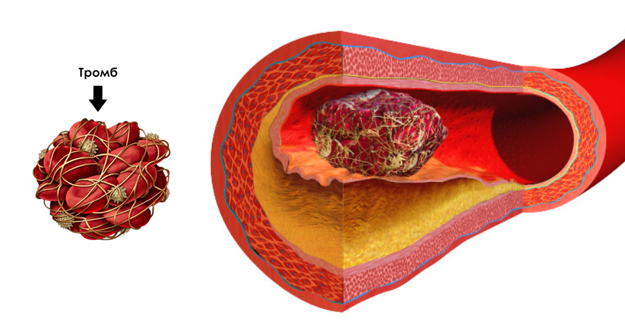 Тромп у человека. Тромбоз кровеносных сосудов. Тромбоэмболия кровеносного сосуда. Тромбоз пузырной артерии. Тромб в кровеносном сосуде.