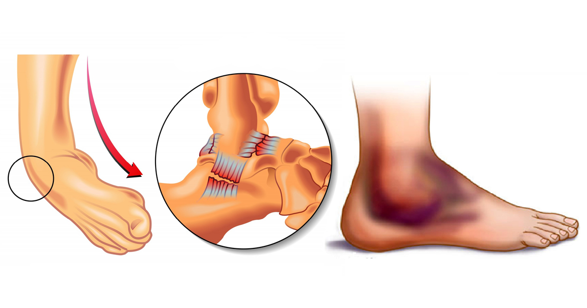 Вывих голеностопного сустава - признаки, причины, симптомы, лечение и профилактика - мебель-дома.рф