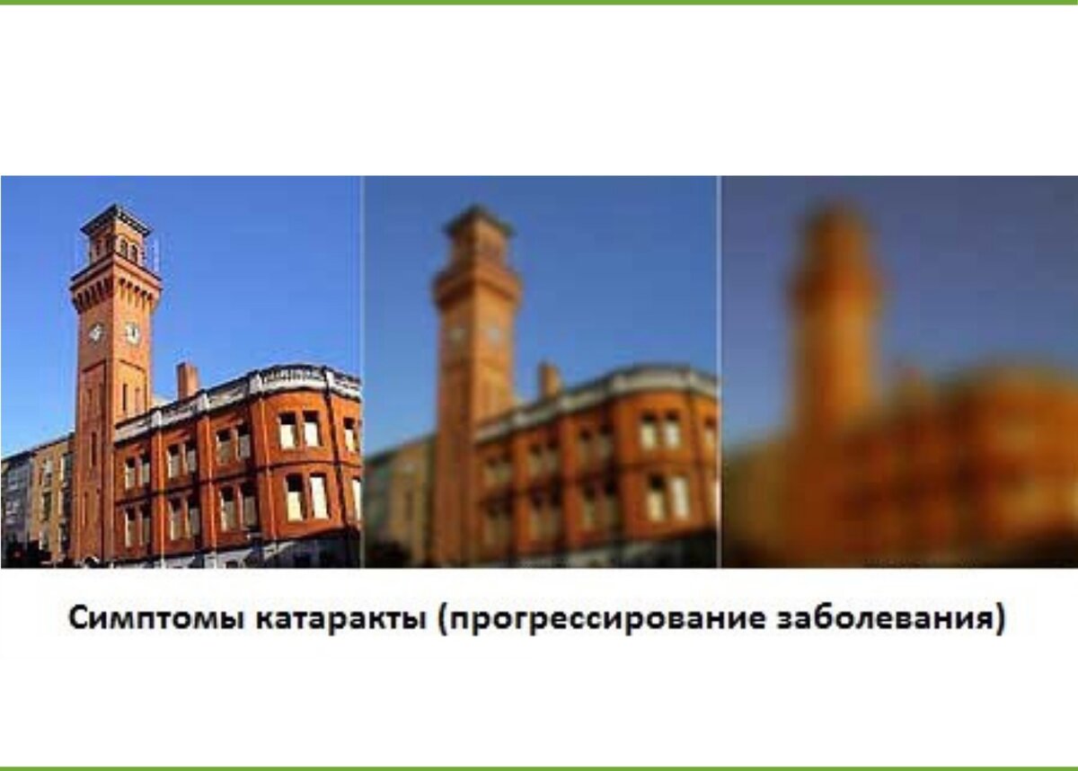 Катаракта | Медицинский центр «Моя клиника» | Дзен