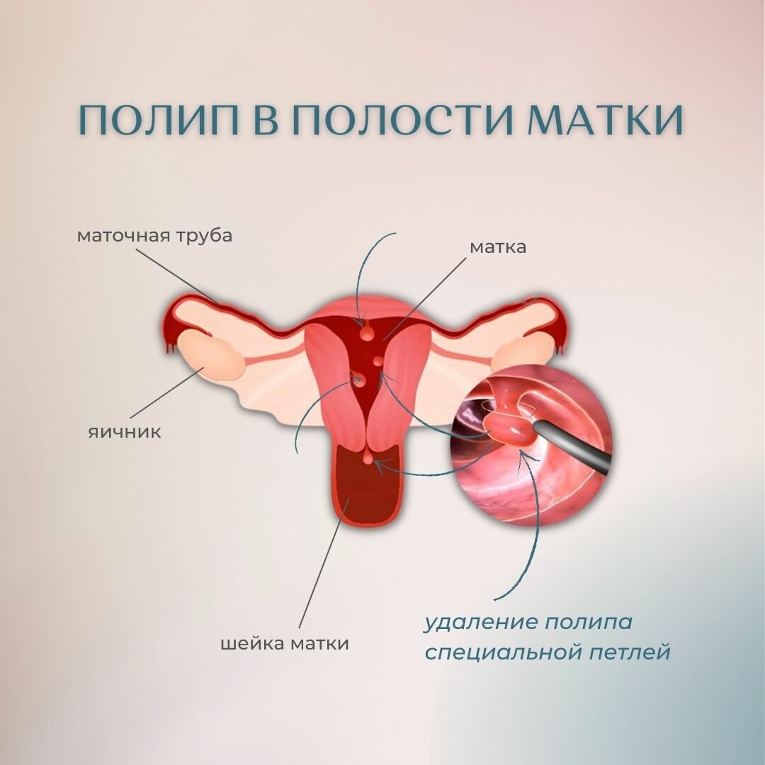 Может ли полип цервикального канала кровать