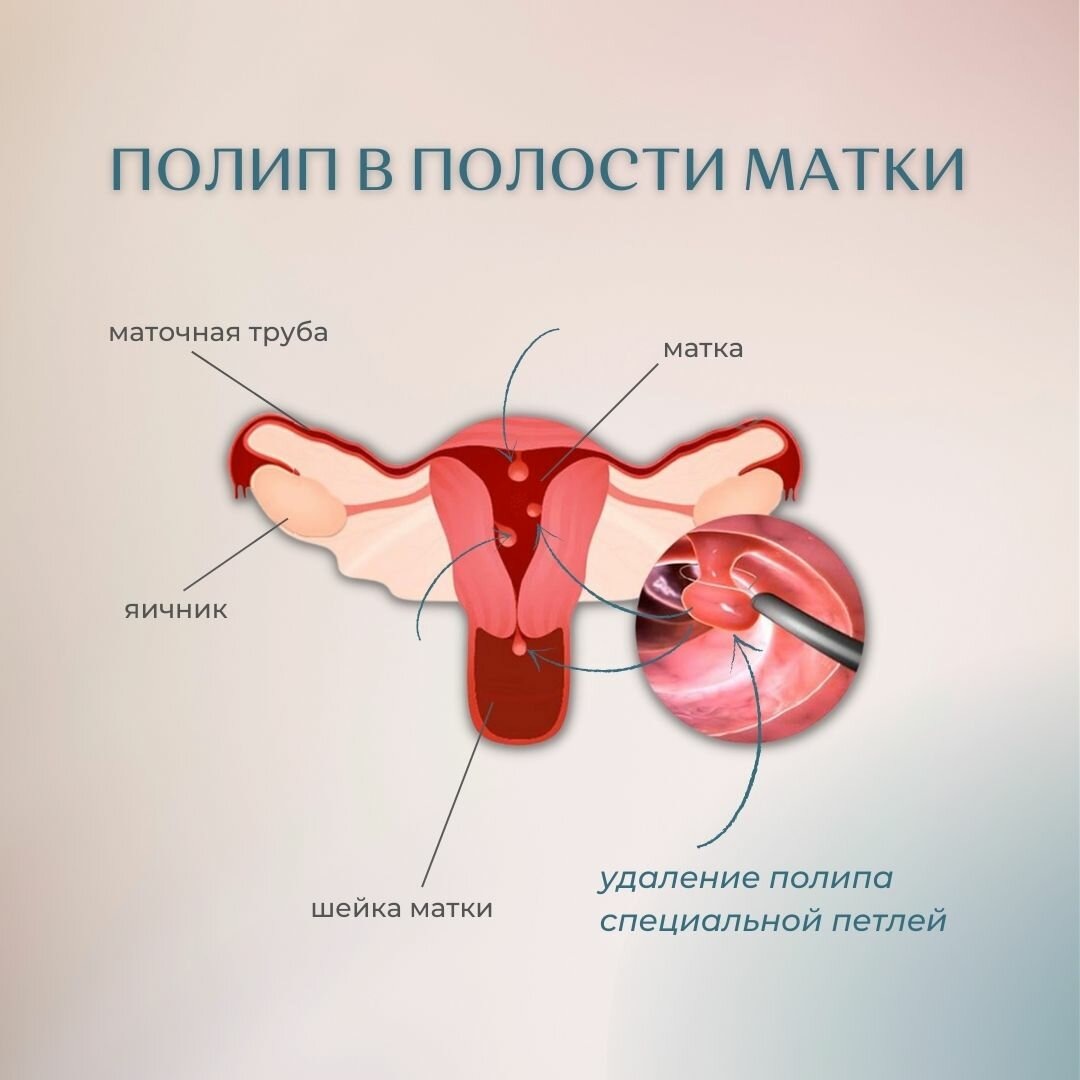 Полипы матки: причины, симптомы, методы диагностики и лечения полипов матки.