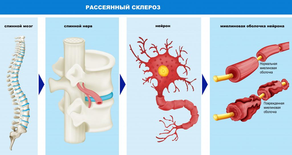 Лечение рассеянного склероза в Израиле